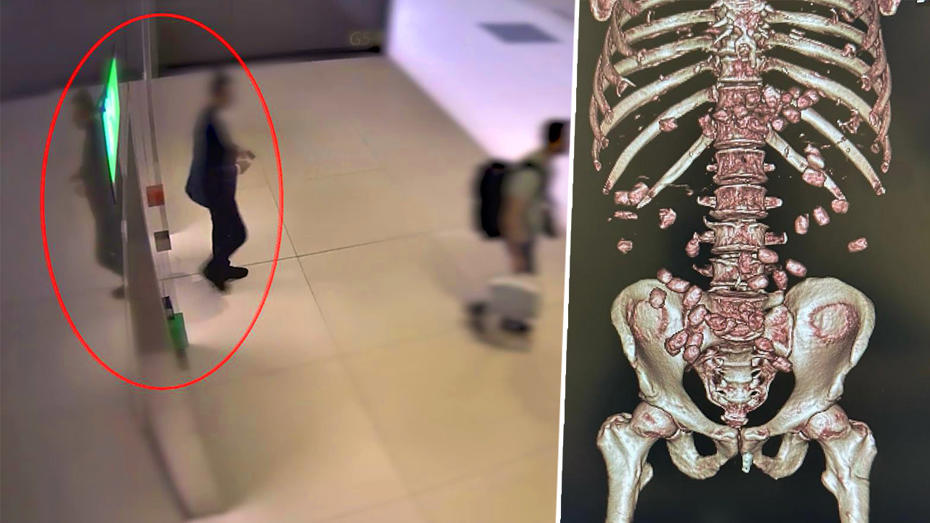 İstanbul Havalimanı'nda yürümekte güçlük çeken yolcunun midesinden 26 kapsül çıktı